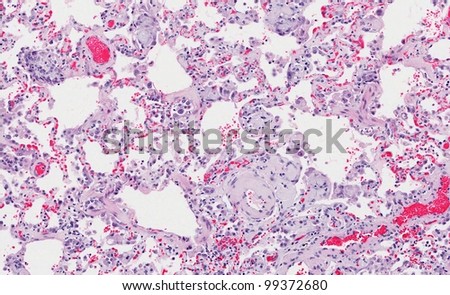 Pulmonary amyloidosis with deposits of pale gray to light pink amyloid protein in blood vessel wall, alveoli. Pneumocytes the lung epithelial cells are prominent.