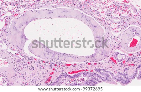 Amyloid deposition in the walls of the pulmonary blood vessels.  Pulmonary artery is expanded by pale gray to light pink amyloid protein and normal smooth muscle cells are lost.