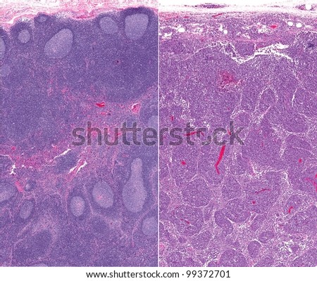 Normal healthy lymph node (left) and lymph node architecture obliterated by lymphoma (right) with sheets of cancer cells. Normal healthy lymphoid follicles with germinal centers in the left image.