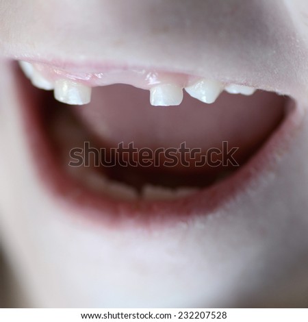 Little child smiling portrait missing front tooth