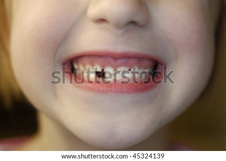 Closeup of little girl with missing teeth