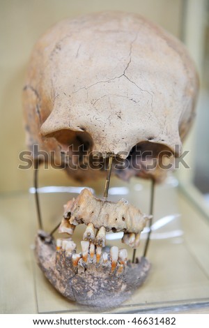 Human skull of inca period- teeth with golden filling - ancient technologies