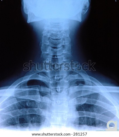 X-ray of neck from back.