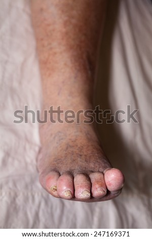 Detail of ill senior female swollen leg with damaged toes and nails.