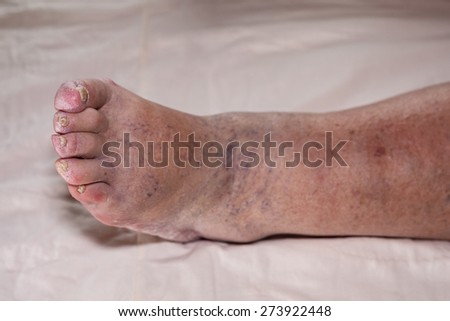Detail of ill senior female swollen leg with damaged toes and nails.