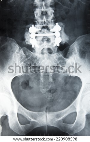 radiography of the back where you can see the nails and put plates in a surgery