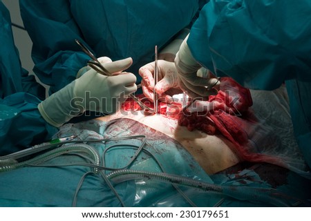 A surgeon team working together on a patient during an oparation in a hospital