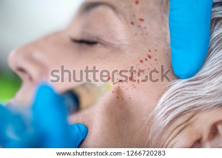 PRP Face Cosmetics Injecting. Beautiful mature woman receives Platelet Rich Plasma face injection treatment for reducing wrinkles. Anti-aging concept.