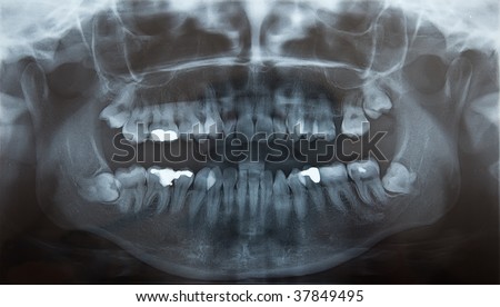 X-Ray of problematic wisdom teeth for extraction, and fillings