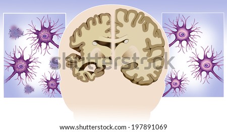 Schematic illustration of the dissection of a healthy brain and one with Alzheimer\'s disease and healthy and diseased neurons