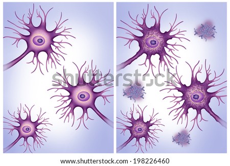 Healthy and Alzheimer\'s disease neurons.