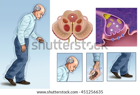 Illustrations elderly person with tremors caused by Parkinson\'s.