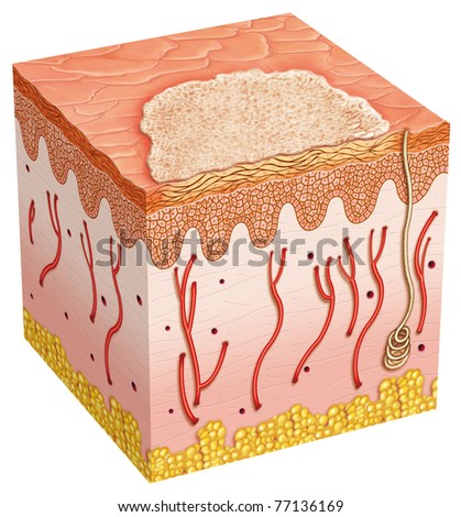 Illustration on the Basal Skin Cancer