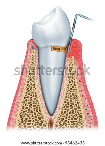 initial periodontitis