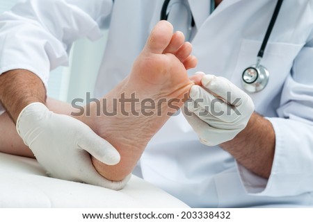 Doctor dermatologist examines the foot on the presence of athlete\'s foot
