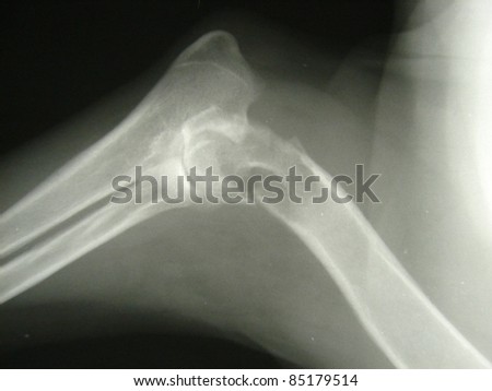Fracture shoulder bone of dog.