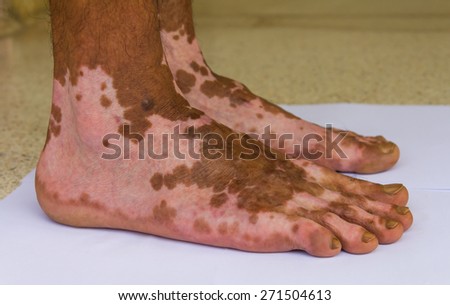 Close up of both feet were burning wound healed scarring unusual pattern.