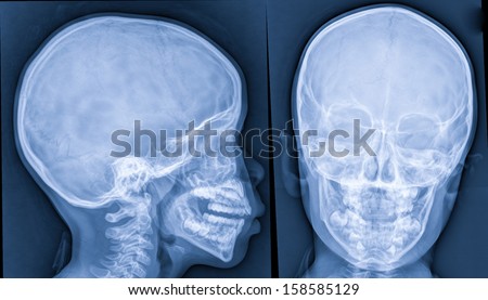X-ray of head,skull x-rays image
