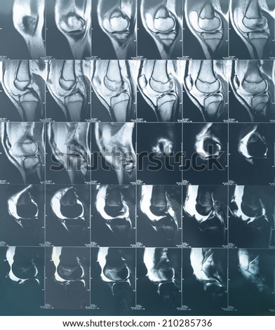 X-ray image of leg bone computed tomography