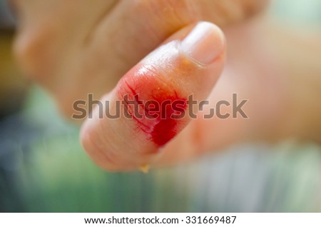 Bleeding from the cut finger of right hand.