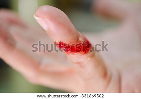 Bleeding from the cut finger of right hand.