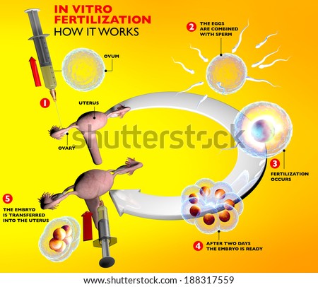 In vitro fertilization, artificial insemination route