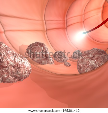 Colonoscopy examination colon digestive system
