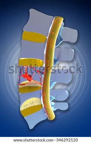Spine, marrow, traumatic fractures vertebral, burst fracture. Spine section