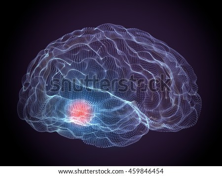 Brain degenerative diseases, Parkinson