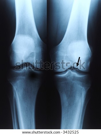 X ray photo of human knee