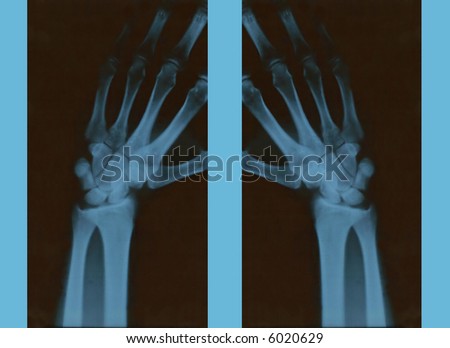Hands X ray