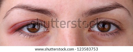 Eye sty. Opened woman\'s eye with sty and health eye.