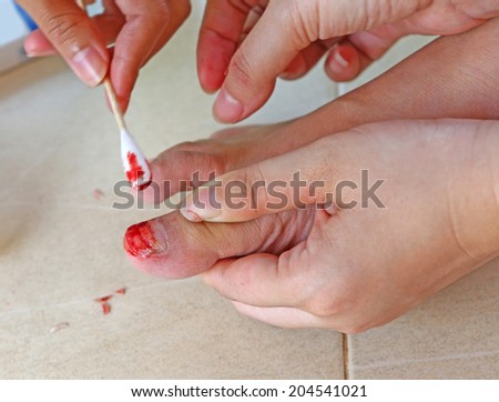 finger toe injured to lose nail, Dressing finger toe injured to lose nail
