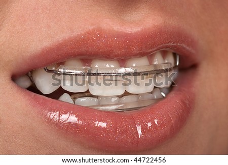 Girl with dental braces ( retainer)