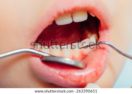 Healthy teeth in mouth of child, course of dental examination