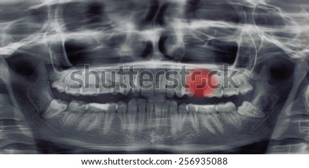 Healthcare and medical concept. Panoramic dental X-Ray of teeth with painful area