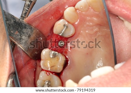 dental implant with cover screw