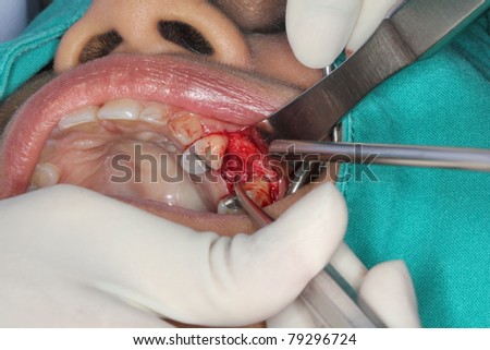 gum surgery