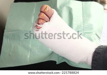 A man with a bandaged diabetic foot infection and toenail fungus
