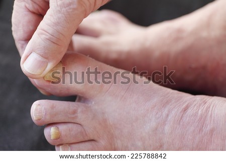 A man checks his athletes foot dry skin.