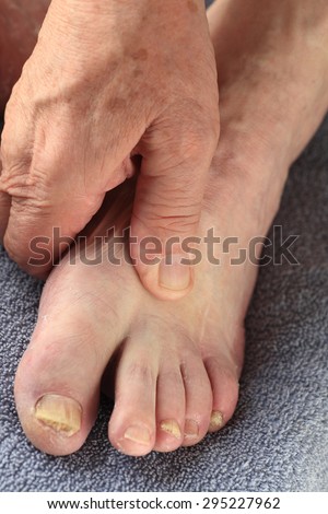 A senior man with a fungal infection on some of his toes