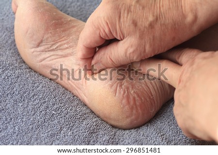 A man peeling his athletes foot dry skin