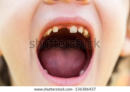 Seven year old boy showing his front missing tooth with mouth wide open