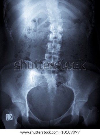 Radiography of a young female spine with severe scoliosis