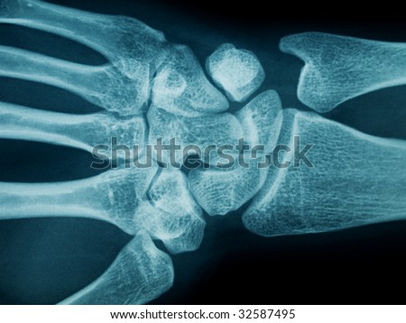 radiography of a middle aged woman hand and wrist