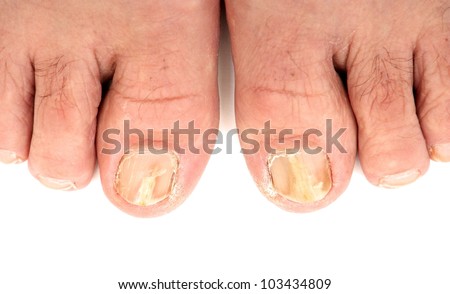 white on toenails