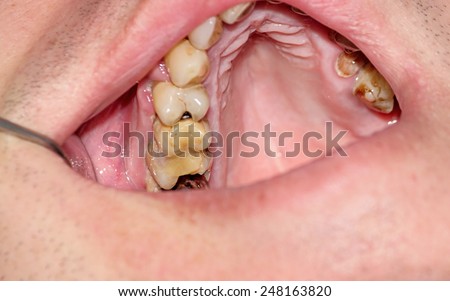 Cavities and old fillings in the upper posterior teeth