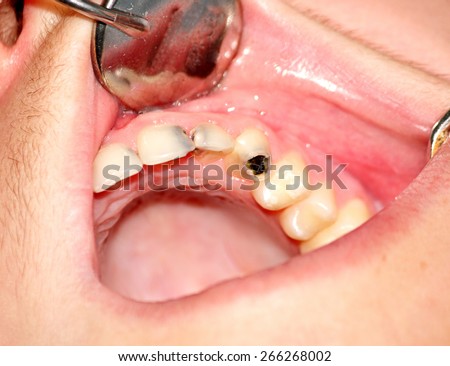 Central incisor, lateral incisor and canine, affected of caries
