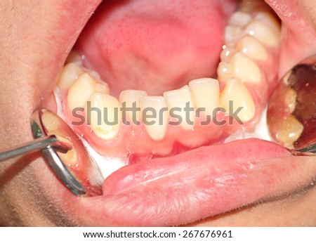 Malocclusion. Crowding of the teeth of the lower jaw