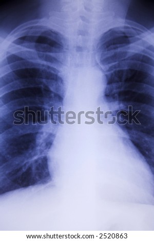 Male chest x-ray with blue hue
